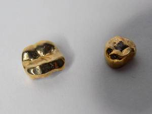 2 Gold Fillings