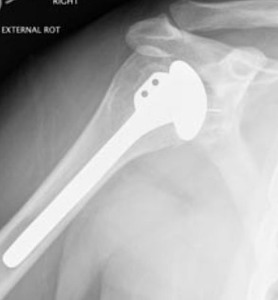lot 54 image: MSRP $2000 Vitallium Shoulder Prosthesis Inplant - Biocompatible Well-Tolerated by the Body, High Resistance to Fatigue - Great Condition