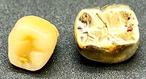lot 54A image: Gold Dental Crown with Natural Tooth Core 3.13g